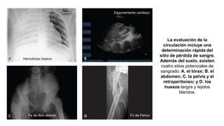 La evaluación de la
circulación incluye una
determinación rápida del
sitio de pérdida de sangre.
Además del suelo, existen
cuatro sitios potenciales de
sangrado: A. el tórax; B. el
abdomen; C. la pelvis y el
retroperitoneo; y D. los
huesos largos y tejidos
blandos.
Hemotórax masivo
Taponamiento cardiaco
Fx de libro abierto Fx de Fémur
 