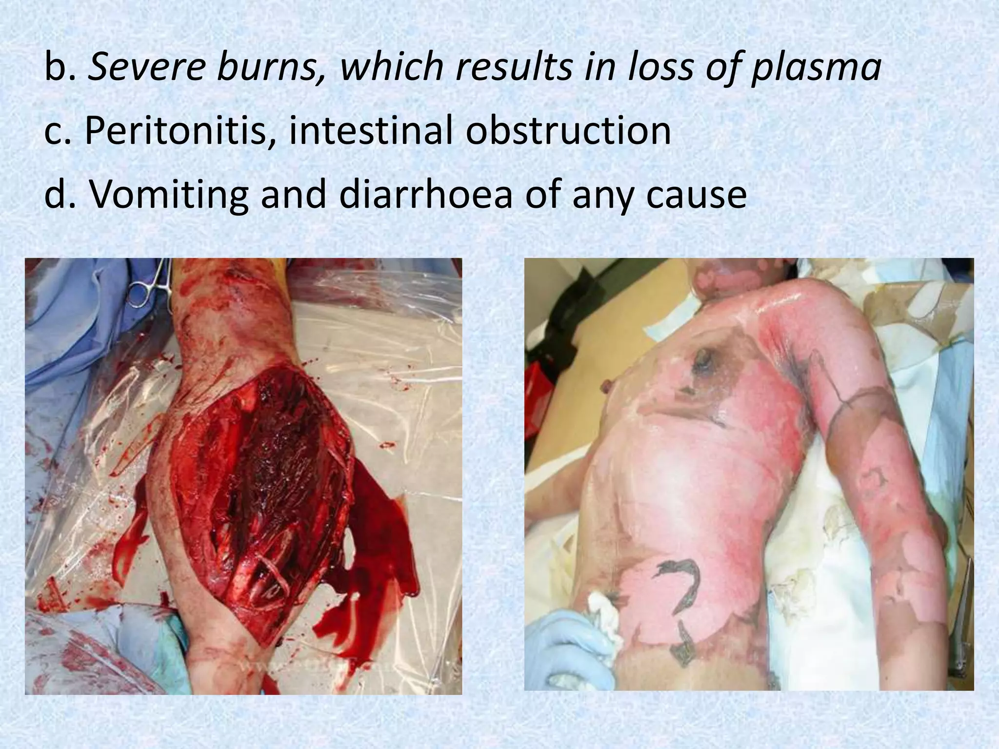 b. Severe burns, which results in loss of plasma
c. Peritonitis, intestinal obstruction
d. Vomiting and diarrhoea of any cause
 