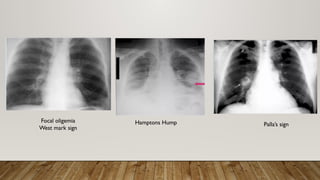 Focal oligemia
West mark sign
Hamptons Hump Palla’s sign
 