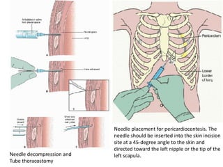 Needle decompression and
Tube thoracostomy
Needle placement for pericardiocentesis. The
needle should be inserted into the skin incision
site at a 45-degree angle to the skin and
directed toward the left nipple or the tip of the
left scapula.
 