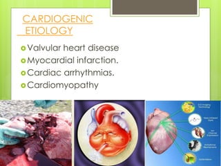 Valvular heart disease
Myocardial infarction.
Cardiac arrhythmias.
Cardiomyopathy
CARDIOGENIC
ETIOLOGY
 