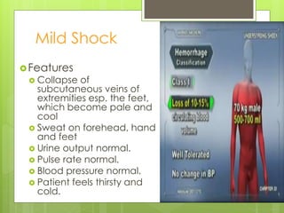Mild Shock
Features
 Collapse of
subcutaneous veins of
extremities esp. the feet,
which become pale and
cool
 Sweat on forehead, hand
and feet
 Urine output normal.
 Pulse rate normal.
 Blood pressure normal.
 Patient feels thirsty and
cold.
 