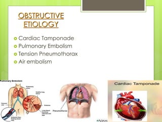 OBSTRUCTIVE
ETIOLOGY
 Cardiac Tamponade
 Pulmonary Embolism
 Tension Pneumothorax
 Air embolism
 