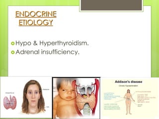 ENDOCRINE
ETIOLOGY
Hypo & Hyperthyroidism.
Adrenal insufficiency.
 