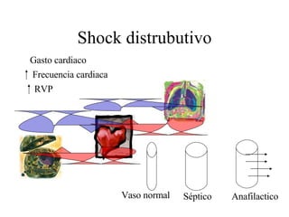 Shock distrubutivo Gasto cardiaco Frecuencia cardiaca RVP Vaso normal Séptico Anafilactico 