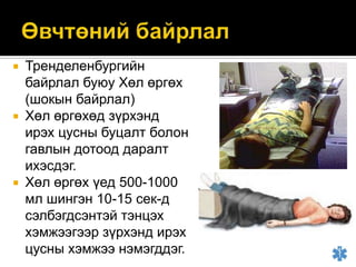 Тренделенбургийн
байрлал буюу Хөл өргөх
(шокын байрлал)
 Хөл өргөхөд зүрхэнд
ирэх цусны буцалт болон
гавлын дотоод даралт
ихэсдэг.
 Хөл өргөх үед 500-1000
мл шингэн 10-15 сек-д
сэлбэгдсэнтэй тэнцэх
хэмжээгээр зүрхэнд ирэх
цусны хэмжээ нэмэгддэг.


 