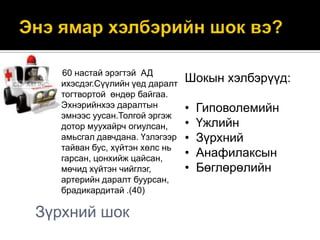 60 настай эрэгтэй АД
ихэсдэг.Сүүлийн үед даралт
тогтвортой өндөр байгаа.
Эхнэрийнхээ даралтын
эмнээс уусан.Толгой эргэж
дотор муухайрч огиулсан,
амьсгал давчдана. Үзлэгээр
тайван бус, хүйтэн хөлс нь
гарсан, цонхийж цайсан,
мөчид хүйтэн чийглэг,
артерийн даралт буурсан,
брадикардитай .(40)

Зүрхний шок

Шокын хэлбэрүүд:
•
•
•
•
•

Гиповолемийн
Үжлийн
Зүрхний
Анафилаксын
Бөглөрөлийн

 