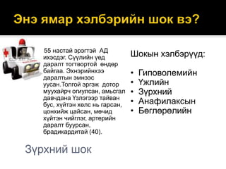 55 настай эрэгтэй АД
ихэсдэг. Сүүлийн үед
даралт тогтвортой өндөр
байгаа. Эхнэрийнхээ
даралтын эмнээс
уусан.Толгой эргэж дотор
муухайрч огиулсан, амьсгал
давчдана Үзлэгээр тайван
бус, хүйтэн хөлс нь гарсан,
цонхийж цайсан, мөчид
хүйтэн чийглэг, артерийн
даралт буурсан,
брадикардитай (40).

Зүрхний шок

Шокын хэлбэрүүд:
•
•
•
•
•

Гиповолемийн
Үжлийн
Зүрхний
Анафилаксын
Бөглөрөлийн

 