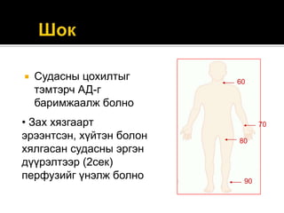 

Судасны цохилтыг
тэмтэрч АД-г
баримжаалж болно

• Зах хязгаарт
эрээнтсэн, хүйтэн болон
хялгасан судасны эргэн
дүүрэлтээр (2сек)
перфузийг үнэлж болно

60

70
80

90

 