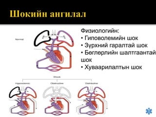 Физиологийн:
• Гиповолемийн шок
• Зүрхний гаралтай шок
• Бөглөрлийн шалтгаантай
шок
• Хуваарилалтын шок
 