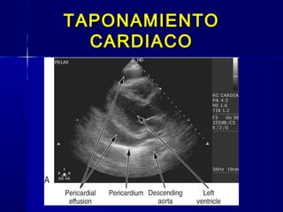 TAPONAMIENTOTAPONAMIENTO
CARDIACOCARDIACO
 