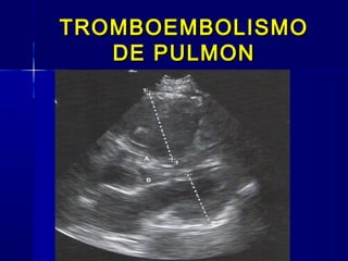 TROMBOEMBOLISMOTROMBOEMBOLISMO
DE PULMONDE PULMON
 