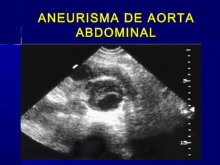 ANEURISMA DE AORTAANEURISMA DE AORTA
ABDOMINALABDOMINAL
 