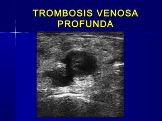 TROMBOSIS VENOSATROMBOSIS VENOSA
PROFUNDAPROFUNDA
 