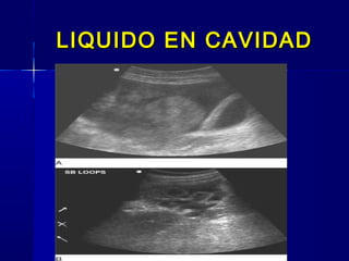 LIQUIDO EN CAVIDADLIQUIDO EN CAVIDAD
 
