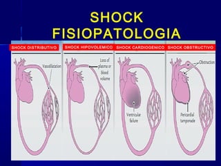 SHOCK
FISIOPATOLOGIA
SHOCK DISTRIBUTIVO SHOCK HIPOVOLEMICO SHOCK CARDIOGENICO SHOCK OBSTRUCTIVO
 