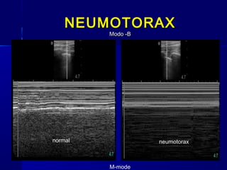 NEUMOTORAXNEUMOTORAX
Modo -BModo -B
M-mode
normal neumotorax
 