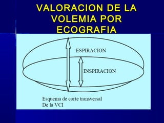 VALORACION DE LAVALORACION DE LA
VOLEMIA PORVOLEMIA POR
ECOGRAFIAECOGRAFIA
 