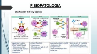 FISIOPATOLOGIA
Clasificación de Gell y Coombs
 