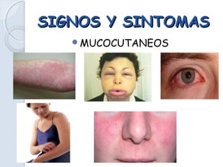 SIGNOS Y SINTOMASSIGNOS Y SINTOMAS
MUCOCUTANEOS
 