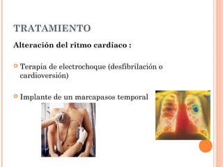 TRATAMIENTO
Alteración del ritmo cardíaco :
 Terapia de electrochoque (desfibrilación o
cardioversión)
 Implante de un marcapasos temporal
 