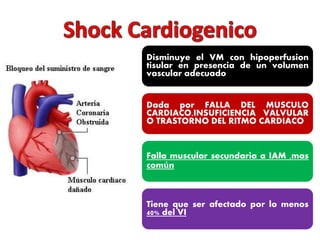 Disminuye el VM con hipoperfusion 
tisular en presencia de un volumen 
vascular adecuado 
Dada por FALLA DEL MUSCULO 
CARDIACO,INSUFICIENCIA VALVULAR 
O TRASTORNO DEL RITMO CARDIACO 
Falla muscular secundaria a IAM ,mas 
común 
Tiene que ser afectado por lo menos 
40% del VI 
 