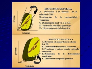 Fisiopatología Volumen latido 50 ml Volumen latido 70 ml 