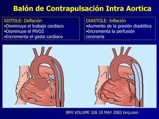 SISTOLE: Deflación Disminuye el trabajo cardiaco Disminuye el MVO2 Incrementa el gasto cardiaco DIASTOLE: Inflación Aumento de la presión diastólica Incrementa la perfusión coronaria Balón de Contrapulsación Intra Aortica BMJ VOLUME 326 10 MAY 2003 bmj.com 