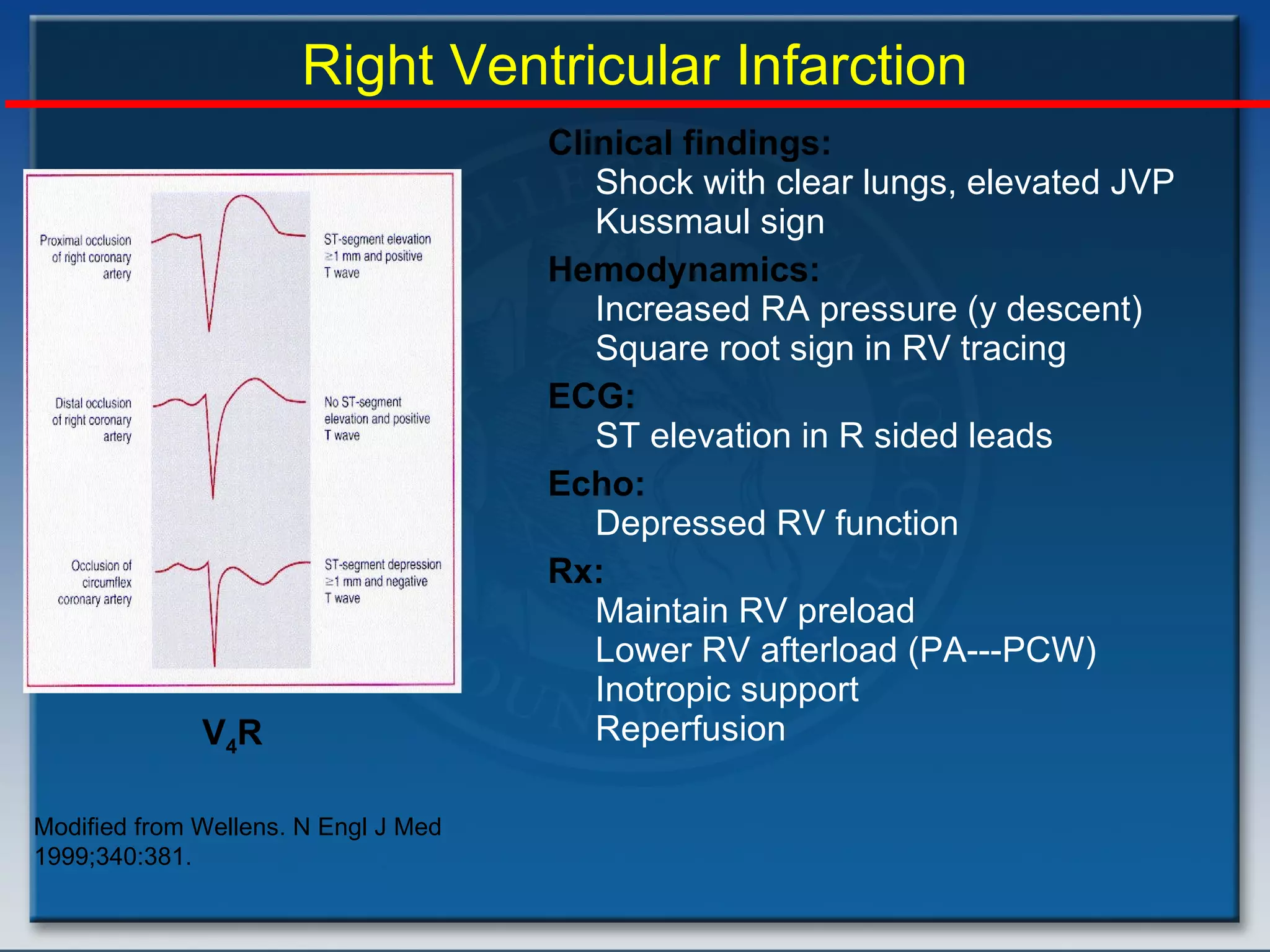 Right Ventricular Infarction Clinical findings: Shock with clear lungs, elevated JVP Kussmaul sign Hemodynamics:  Increased RA pressure (y descent) Square root sign in RV tracing ECG: ST elevation in R sided leads Echo: Depressed RV function Rx: Maintain RV preload Lower RV afterload (PA---PCW) Inotropic support Reperfusion V 4 R  Modified from Wellens. N Engl J Med 1999;340:381. 