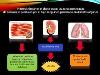 Necrosis tisular en el shock grave: las zonas parcheadas
de necrosis se producen por el flujo sanguíneo parcheado en distintos órganos
Las lesiones cardíacas
tienen un importante
papel en el camino hasta
la etapa final irreversible
del shock
Insuficiencia renal
UREMIA
Síndrome del
pulmón de
shock
 