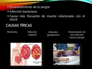  Envenenamiento de la sangre
 Infección bacteriana
 Causa más frecuente de muerte relacionada con el
shock
CAUSAS TÍPICAS
Peritonitis Infección
gangrenosa
Infección
corporal
Diseminación de
una infección
hacia la sangre
 