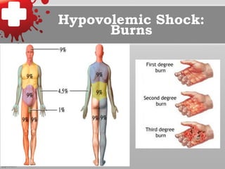 Hypovolemic Shock:
Burns
 