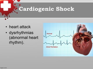 Cardiogenic Shock
•  heart attack
•  dysrhythmias
(abnormal heart
rhythm).
 