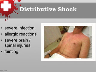Distributive Shock
•  severe infection
•  allergic reactions
•  severe brain /
spinal injuries
•  fainting.
 