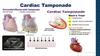 Cardiac Tamponade
v
 