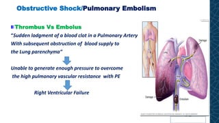 Obstructive Shock/Pulmonary Embolism
Thrombus Vs Embolus
“Sudden lodgment of a blood clot in a Pulmonary Artery
With subsequent obstruction of blood supply to
the Lung parenchyma”
Unable to generate enough pressure to overcome
the high pulmonary vascular resistance with PE
Right Ventricular Failure
 