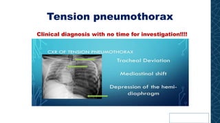 Tension pneumothorax
Clinical diagnosis with no time for investigation!!!!
 