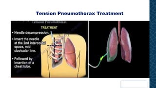 Tension Pneumothorax Treatment
 