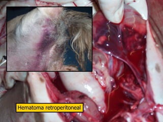 Hematoma retroperitoneal
 