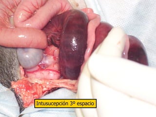 Intusucepción 3º espacio
 
