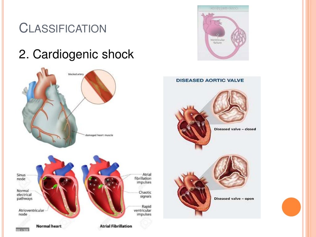 Shock (Circulatory shock)