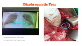 Diaphragmatic Tear
Continuous diaphragm sign on CXR
Rx - Laparoscopic diaphragmatic repair
 
