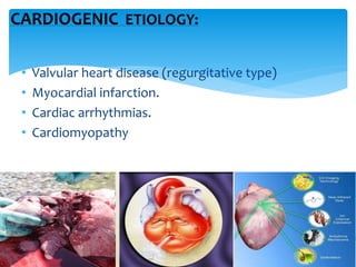 • Valvular heart disease (regurgitative type)
• Myocardial infarction.
• Cardiac arrhythmias.
• Cardiomyopathy
CARDIOGENIC ETIOLOGY:
 