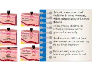Extracorporeal shock wave therapy in physiotherapy | PDF