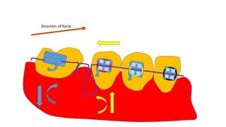 Direction of force
 