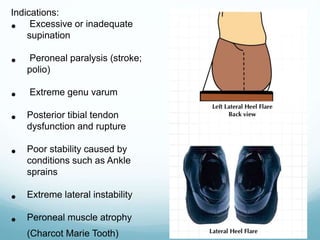 Indications:
• Excessive or inadequate
supination
• Peroneal paralysis (stroke;
polio)
• Extreme genu varum
• Posterior tibial tendon
dysfunction and rupture
• Poor stability caused by
conditions such as Ankle
sprains
• Extreme lateral instability
• Peroneal muscle atrophy
(Charcot Marie Tooth)
 