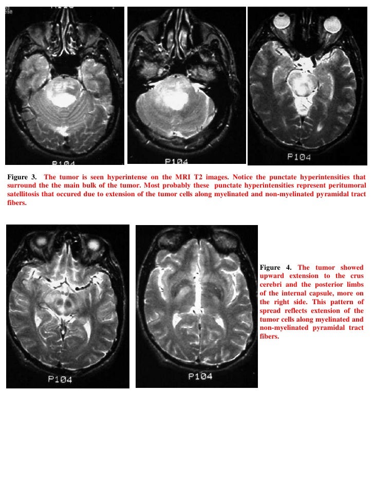 Short case...brain stem glioma