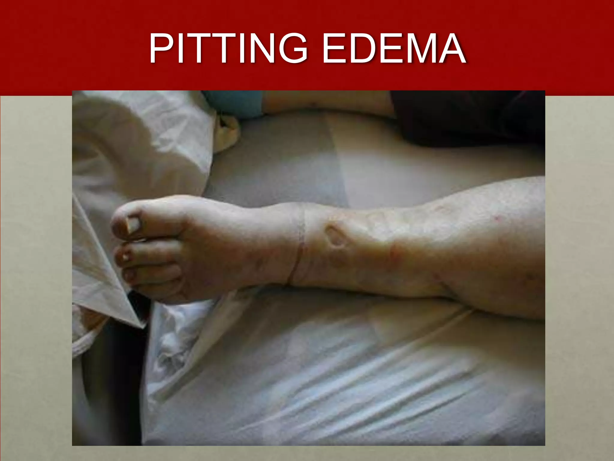 PITTING EDEMA