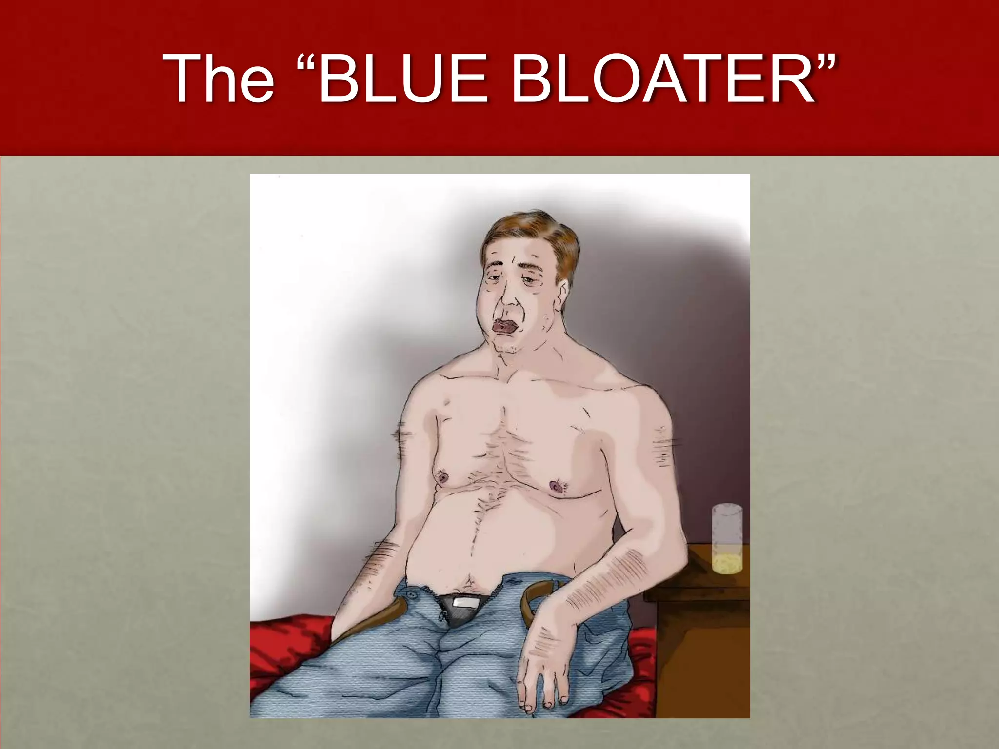 The “BLUE BLOATER”