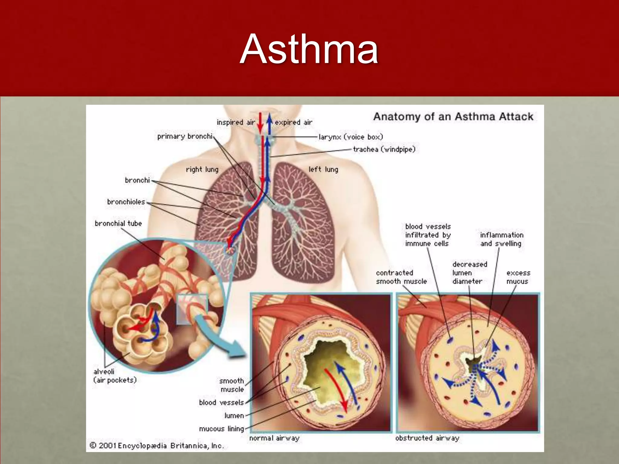 Asthma